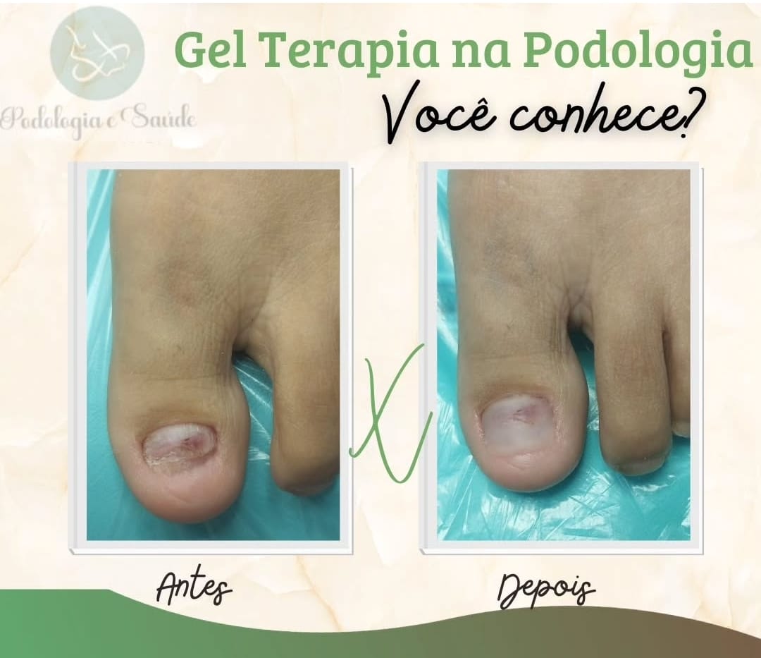Procedimento de gel terapia para trauma ungueal em andamento