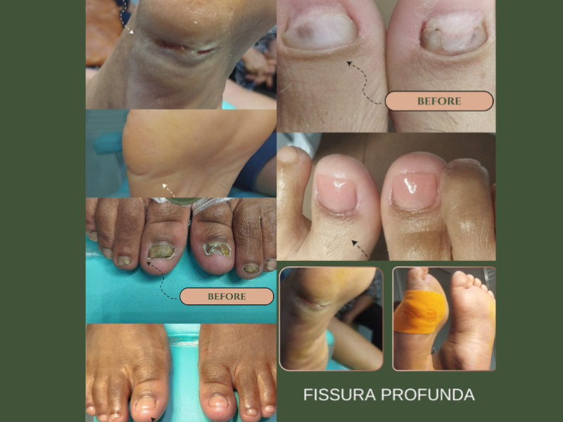 Antes e depois de tratamento de fissuras nos pés, mostrando a pele hidratada e saudável